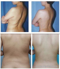 360吸脂手术全过程图片，360吸脂减肥