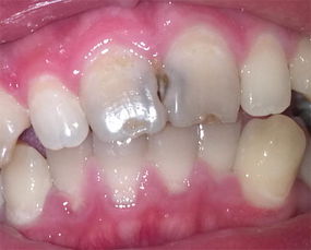 门牙蛀牙修复大概多少钱，门牙蛀牙掉了一半还能补吗