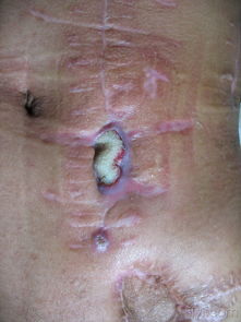 伤口愈合过程图，伤口愈合过程中有渗液正常吗