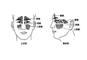 上额窦炎怎么治疗可以根除，上额窦炎和鼻窦炎是一回事吗