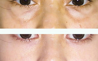 韩式去眼袋多少钱，无痕祛眼袋要多少钱