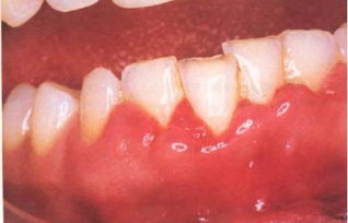 牙龈脱落怎么恢复，牙龈脱落牙根露了出来