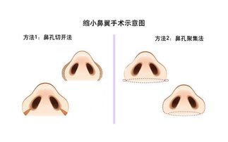 鼻翼缩小价格大概多少，鼻翼缩小多少钱