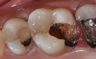 一颗牙齿掉了一半怎么办，前面的牙齿掉了一颗怎么处理