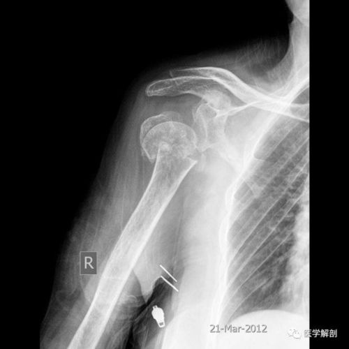 外科颈和解剖颈的区别，外科颈名词解释