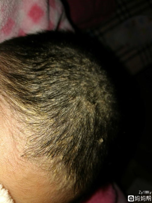 孩子头皮上有白屑图片大全，孩子头皮上有白屑图片和症状