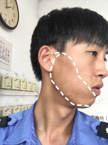 脸颊两边发黑是什么原因引起的，脸颊两侧发黑怎么解决
