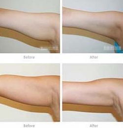 手臂吸脂减肥价格，手臂吸脂减肥手术