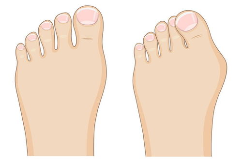 大拇指外翻是什么原因，大拇指外翻