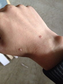 十几年的疤痕能去除吗，手腕上的疤怎么去掉