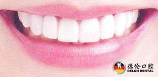 美白牙齿有什么危害，牙齿美容美白多少钱