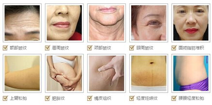 fotona4d面部拉皮除皱价格，拉皮除皱价格表
