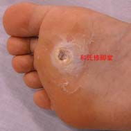 鸡眼的图片 初期 跖疣，鸡眼的图片,症状和处理方法