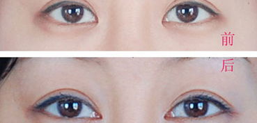 只开眼角多少钱，开内眼角手术价格多少