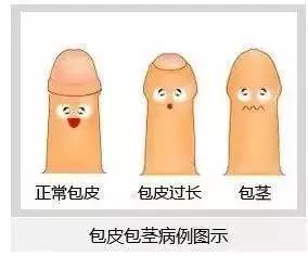 做完包茎手术恢复正常图片，包茎做手术多久恢复