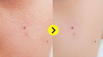 男子背部挤出超大螨虫视频，男子背部挤出超大螨虫图片