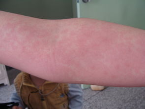 环形红斑图片，多形红斑消退过程图片