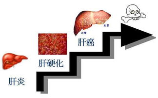 失代偿期是什么意思，失代偿期可以转为代偿期吗