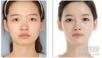 垫鼻子的副作用有哪些，垫鼻子的副作用是什么