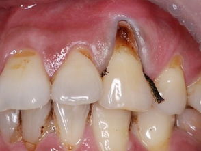 牙根发黑腐烂怎么治疗，牙龈发黑如何恢复正常