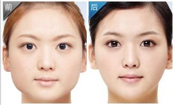 面部吸脂恢复期，面部吸脂多久恢复