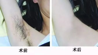 怎么去腋下的毛?，怎么去腋下的毛发