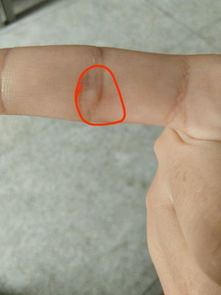 手关节有个凸起的硬包，手指关节鼓个硬疙瘩图片