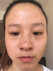 脸上越来越多斑怎么回事，脸上斑越来越多是什么原因