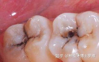 蛀牙是什么样的图片，蛀牙是什么样子的