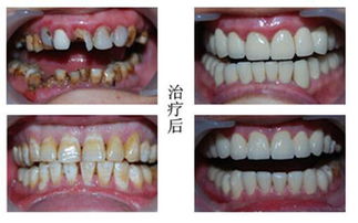 做个牙大概多少钱一个，做一口牙要多少钱