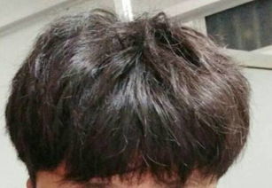 移植毛囊改变自然卷，头发自然卷怎么变直