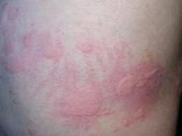 虫咬皮炎症能自愈吗，被螨虫咬的症状图片