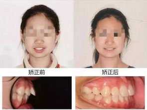 整牙齿矫正有年龄限制吗，牙齿矫正年龄有限制吗