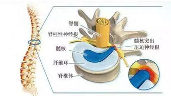 腰椎膨出怎么锻炼方法，腰椎膨出怎么锻炼方法视频