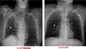 瘗怎么读音，痿怎么读