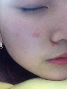 红痘印一般多久会消失
