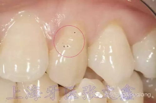 抛光对牙齿有伤害吗