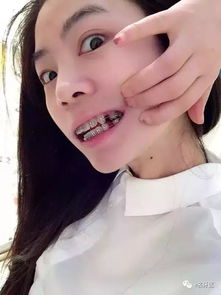 怎么矫正虎牙