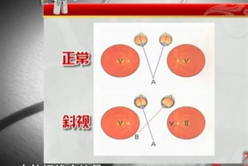 求大神解释为什么近视容易引起外隐斜