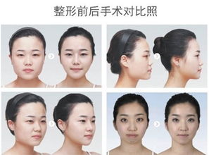 改脸型要多少钱
