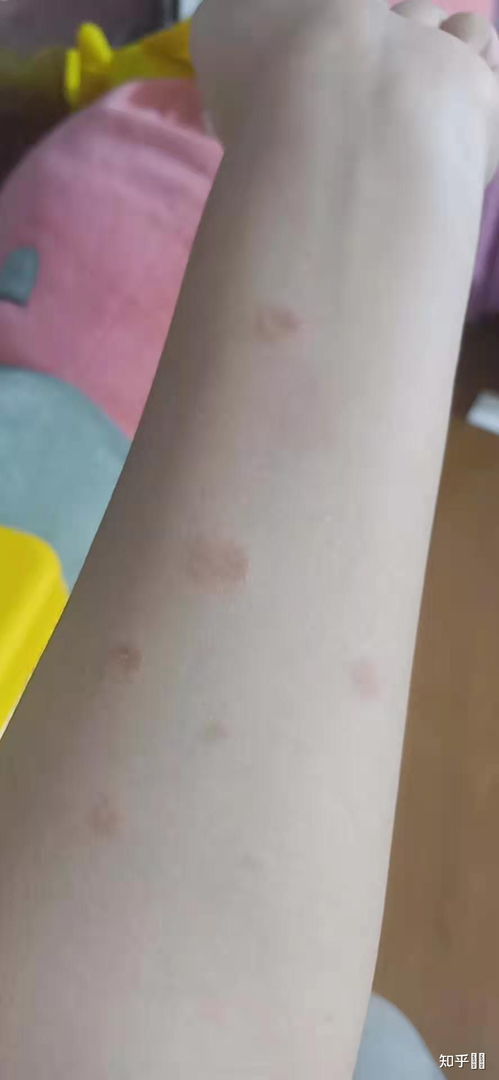人长猫藓是什么样子的