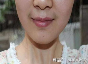 女士胡子怎么去除的方法