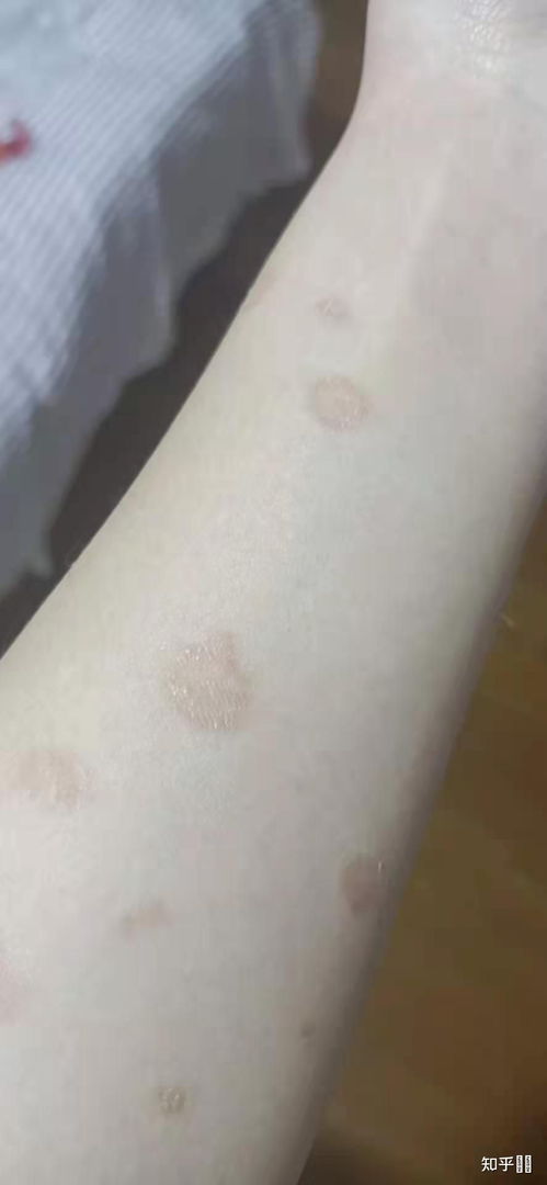 人长猫藓是什么样子的
