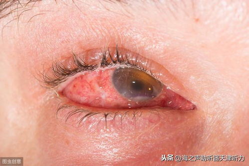 上火眼睛疼怎么办
