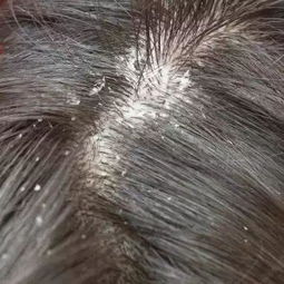 起头皮屑是什么原因导致的
