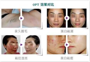 opt美容收缩毛孔的效果怎么样_整形美容医院