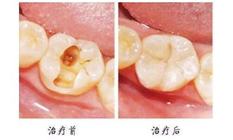 儿童蛀牙图片??