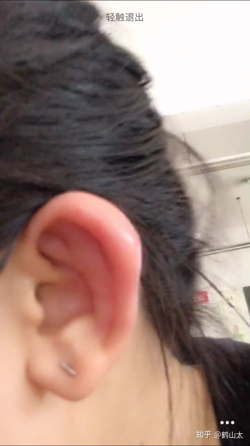 耳洞打耳洞之后肿了怎么办