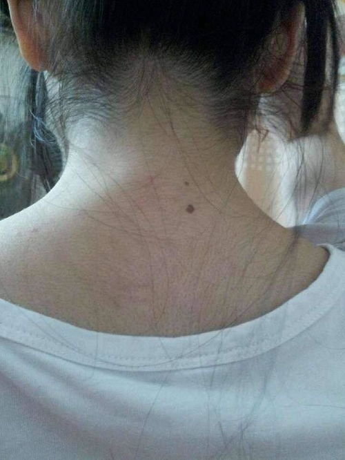 女孩子脖子正中间有颗痣说明什么