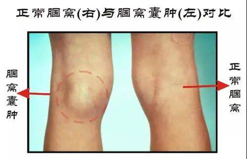 膝关节置换后腘窝囊月中还用治吗?能自瘉吗